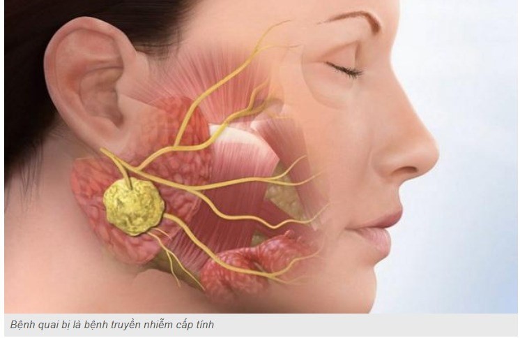 Phòng bệnh quai bị xuất hiện vào mùa Đông Xuân