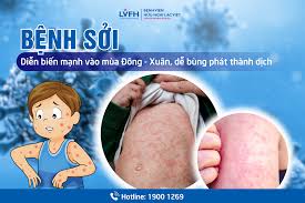 Chủ động phòng, chống bệnh sởi